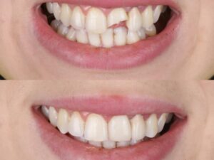 Before and after photo showing a chipped front tooth repaired with cosmetic bonding at Ridgetop Dental, highlighting natural color and shape restoration.