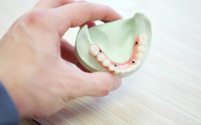 Your Guide to Full-Arch Dental Implants in Sterling, VA
